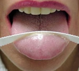 歯磨きで舌を磨くと口が臭くなる – 口臭対策のための「舌クリーナー」という道具