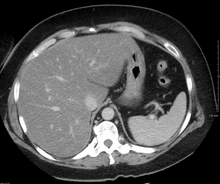 CTによって撮影された脂肪肝